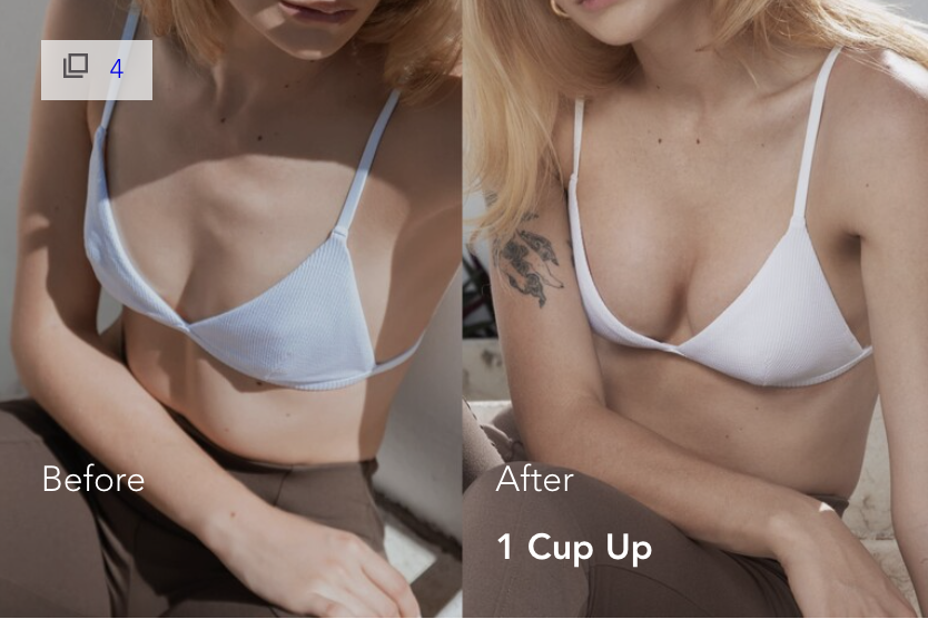 mia-femtech-breast-implant-harmonization-istanbul-3 Mia Femtech Breast Implant Harmonization Before After