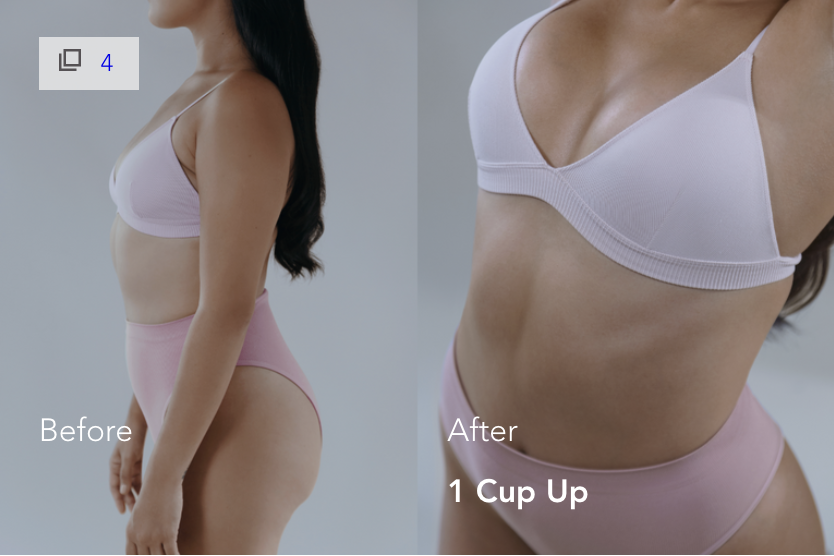 mia-femtech-breast-implant-harmonization-istanbul-4 Mia Femtech Breast Implant Harmonization Before After