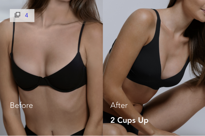 mia-femtech-breast-implant-harmonization-istanbul-6 Mia Femtech Breast Implant Harmonization Before After